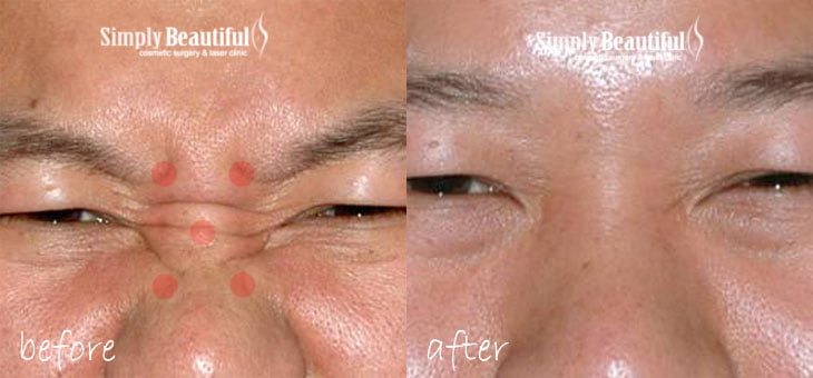 anti wrinkle injections - Dr Peter Kim