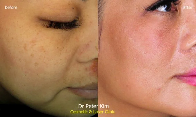 laser freckle removal for Asian & Ethinic skin