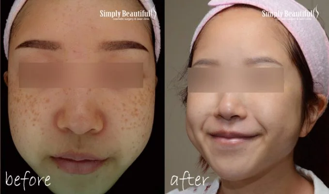 laser freckle removal for Asian & Ethinic skin