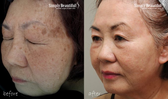 Asian & Ethnic Laser Skin Rejuvenation - Laser Skin Whitening - Dr Peter Kim