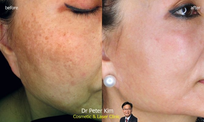 Laser Melasma Treatment for Asian, Brown and Ethnic Skin - Dr Peter Kim