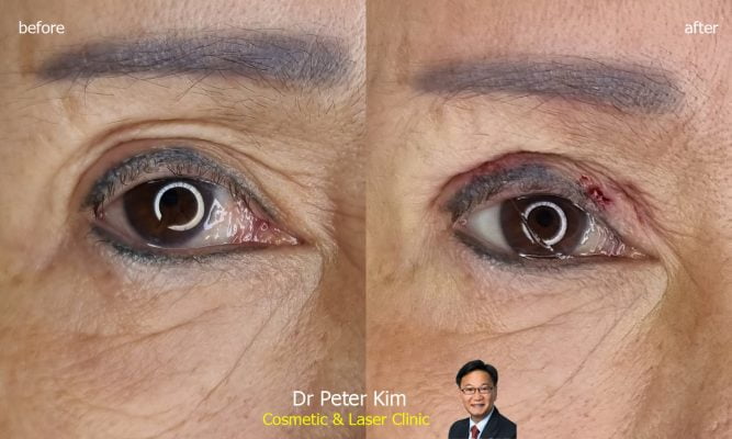 Double eyelid revision surgery - using durable suture technique - Dr Peter Kim