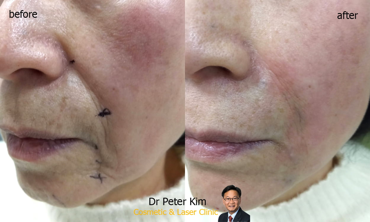 Chin Dermal Filler Injection Dr Peter Kim Cosmetic & Laser Clinic
